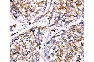 IHC-P: Caspase-4 antibody testing of human breast cancer tissue (Caspase 4 antibody  (AA 104-124))