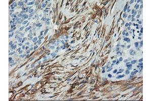 Immunohistochemical staining of paraffin-embedded Adenocarcinoma of Human breast tissue using anti-CNN2 mouse monoclonal antibody. (CNN2 antibody)