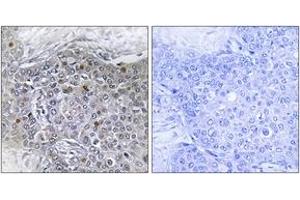 Immunohistochemistry analysis of paraffin-embedded human breast carcinoma tissue, using ZMY11 Antibody. (ZMYND11 antibody  (AA 111-160))