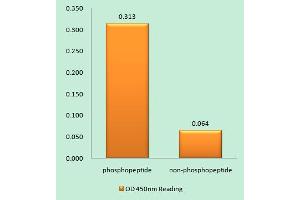 Immunohistochemistry analysis of paraffin-embedded human breast carcinoma tissue using Girdin (Phospho-Ser1417) antibody. (Girdin antibody  (pSer1417))