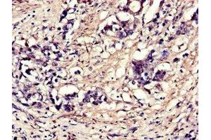 Immunohistochemistry of paraffin-embedded human gastric cancer using ABIN7152114 at dilution of 1:100 (EIF4A3 antibody  (AA 6-166))