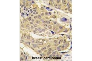 Formalin-fixed and paraffin-embedded human breast carcinoma tissue reacted with EPRS antibody (N-term) (ABIN391816 and ABIN2841664) , which was peroxidase-conjugated to the secondary antibody, followed by DAB staining.