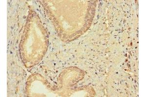 Immunohistochemistry of paraffin-embedded human prostate cancer using ABIN7147459 at dilution of 1:100 (CERKL antibody  (AA 1-558))