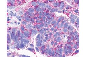Anti-CCRL2 antibody IHC of human Ovary, Carcinoma. (CCRL2 antibody  (Cytoplasmic Domain))