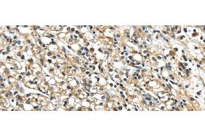 Immunohistochemistry of paraffin-embedded Human prostate cancer using NME2 Polyclonal Antibody at dilution of 1/40 (NME2 antibody)
