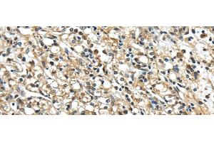 Immunohistochemistry of paraffin-embedded Human prostate cancer using NME2 Polyclonal Antibody at dilution of 1/40 (NME2 antibody)