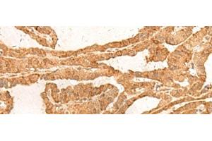 Immunohistochemistry of paraffin-embedded Human thyroid cancer tissue using ZBTB8A Polyclonal Antibody at dilution of 1:100(x200) (ZBTB8A antibody)