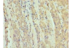 Immunohistochemistry of paraffin-embedded human colon cancer using ABIN7171070 at dilution of 1:100 (SMARCB1 antibody  (AA 86-385))