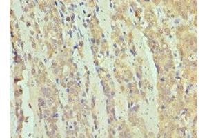 Immunohistochemistry of paraffin-embedded human colon cancer using ABIN7171070 at dilution of 1:100 (SMARCB1 antibody  (AA 86-385))