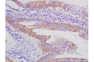 Formalin-fixed and paraffin embedded human colon carcinoma labeled with Rabbit Anti AXL/UFO Polyclonal Antibody, Unconjugated (ABIN756022) at 1:200 followed by conjugation to the secondary antibody and DAB staining (AXL antibody  (AA 151-250))