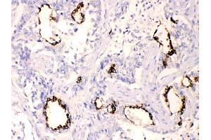 Anterior Gradient 2 was detected in paraffin-embedded sections of  human lung cancer tissues using rabbit anti- Anterior Gradient 2 Antigen Affinity purified polyclonal antibody (Catalog # ) at 1 µg/mL. (AGR2 antibody  (AA 21-175))