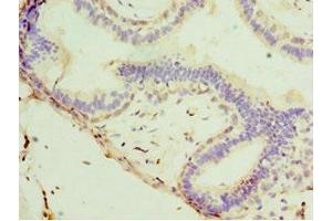 Immunohistochemistry of paraffin-embedded human breast cancer using ABIN7171226 at dilution of 1:100 (Syntaxin 11 antibody  (AA 1-287))