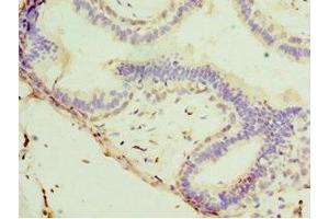 Immunohistochemistry of paraffin-embedded human breast cancer using ABIN7171226 at dilution of 1:100
