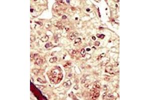 Formalin-fixed and paraffin-embedded human cancer tissue (hepatocarcinoma) reacted with the primary antibody, which was peroxidase-conjugated to the secondary antibody, followed by DAB staining. (STK16 antibody  (C-Term))