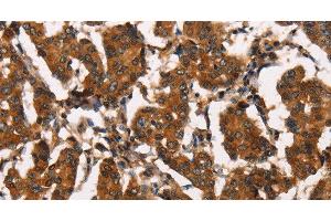 Immunohistochemistry of paraffin-embedded Human breast cancer tissue using ATRN Polyclonal Antibody at dilution 1:50 (Attractin antibody)