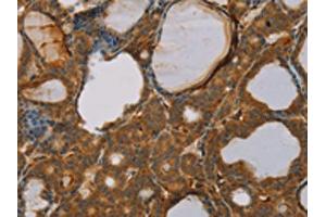 The image on the left is immunohistochemistry of paraffin-embedded Human thyroid cancer tissue using ABIN7130527(PAGE2 Antibody) at dilution 1/20, on the right is treated with fusion protein. (PAGE2 antibody)