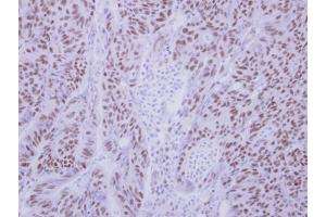 IHC-P Image Immunohistochemical analysis of paraffin-embedded human colon carcinoma, using BS69 antibody, antibody at 1:250 dilution.