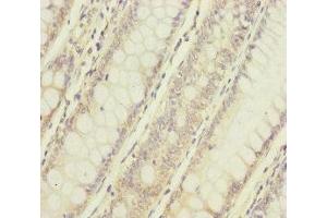 Immunohistochemistry of paraffin-embedded human colon cancer using ABIN7160738 at dilution of 1:100 (NAA25 antibody  (AA 703-972))