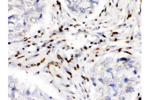 MDMX was detected in paraffin-embedded sections of human lung cancer tissues using rabbit anti- MDMX Antigen Affinity purified polyclonal antibody at 1 μg/mL. (MDM4-binding Protein antibody  (N-Term))