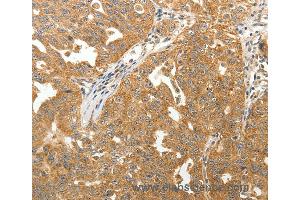 Immunohistochemistry of Human lung cancer using MAP1B  Polyclonal Antibody at dilution of 1:40 (MAP1B antibody)