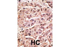 Immunohistochemistry (IHC) image for anti-Small Ubiquitin Related Modifier 4 (SUMO4) (Met55Val-Mutant) antibody (ABIN2996873) (SUMO4 antibody  (Met55Val-Mutant))