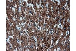 Immunohistochemical staining of paraffin-embedded Adenocarcinoma of endometrium tissue using anti-FAHD2A mouse monoclonal antibody. (FAHD2A antibody)