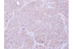 IHC-P Image Immunohistochemical analysis of paraffin-embedded SW480 xenograft, using RAGE, antibody at 1:100 dilution. (MOK antibody)