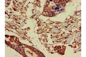 Immunohistochemistry of paraffin-embedded human pancreatic cancer using ABIN7164763 at dilution of 1:100 (PRR11 antibody  (AA 1-360))