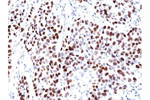 Formalin-fixed, paraffin-embedded human Lung SqCC stained with p21 Mouse Monoclonal Antibody (CIP1/823). (p21 antibody)