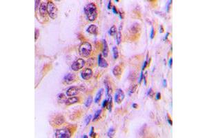 Immunohistochemical analysis of EIF4G2 staining in human liver cancer formalin fixed paraffin embedded tissue section. (EIF4G2 antibody  (N-Term))