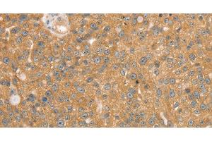 Immunohistochemistry of paraffin-embedded Human breast cancer using SNX2 Polyclonal Antibody at dilution of 1:40 (Sorting Nexin 2 antibody)