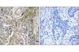 Immunohistochemistry analysis of paraffin-embedded human lung carcinoma tissue, using RHOBTB3 Antibody. (RHOBTB3 antibody  (AA 335-384))
