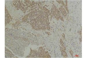 Immunohistochemistry (IHC) analysis of paraffin-embedded Human Breast Carcinoma using CLIC4 Rabbit Polyclonal Antibody diluted at 1:200. (CLIC4 antibody)