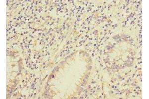 Immunohistochemistry of paraffin-embedded human colon cancer using ABIN7157030 at dilution of 1:100 (IQCC antibody  (AA 181-466))