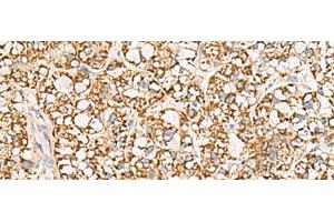 Immunohistochemistry of paraffin-embedded Human liver cancer tissue using ISOC2 Polyclonal Antibody at dilution of 1:95(x200) (ISOC2 antibody)
