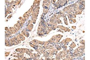 The image on the left is immunohistochemistry of paraffin-embedded Human esophagus cancer tissue using ABIN7127988(PPIL1 Antibody) at dilution 1/30, on the right is treated with fusion protein. (PPIL1 antibody)