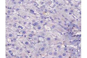 ABIN6267483 at 1/200 staining human liver cancer tissue sections by IHC-P.