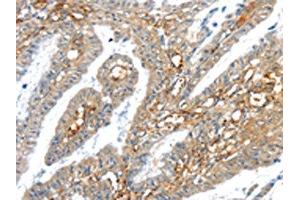 The image on the left is immunohistochemistry of paraffin-embedded Human esophagus cancer tissue using ABIN7192909(TRIM47 Antibody) at dilution 1/30, on the right is treated with synthetic peptide. (TRIM47 antibody)
