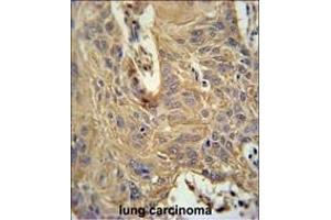 IL5RA Antibody (N-term) (ABIN651428 and ABIN2840234) immunohistochemistry analysis in formalin fixed and paraffin embedded human lung carcinoma followed by peroxidase conjugation of the secondary antibody and DAB staining. (IL5RA antibody  (N-Term))