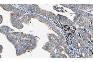 ABIN6272391 at 1/100 staining Human cervical cancer tissue by IHC-P. (MRPL41 antibody)