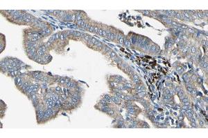 ABIN6272391 at 1/100 staining Human cervical cancer tissue by IHC-P.