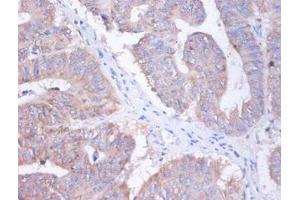 Immunohistochemistry of paraffin-embedded human colon cancer using ABIN7144373 at dilution of 1:100 (AP2S1 antibody  (AA 1-142))