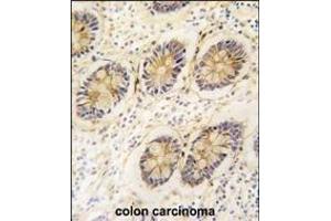 Formalin-fixed and paraffin-embedded human colon carcinoma tissue reacted with AKR1B1 antibody (C-term) (ABIN389205 and ABIN2839363) , which was peroxidase-conjugated to the secondary antibody, followed by DAB staining. (AKR1B1 antibody  (C-Term))