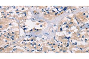 Immunohistochemistry of paraffin-embedded Human thyroid cancer tissue using ADGRB1 Polyclonal Antibody at dilution 1:40 (ADGRB1 antibody)