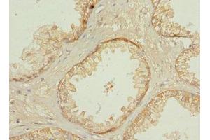 Immunohistochemistry of paraffin-embedded human prostate cancer using ABIN7146273 at dilution of 1:100