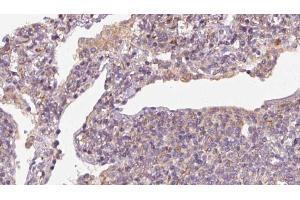 ABIN6273163 at 1/100 staining Human lymph cancer tissue by IHC-P. (SLC38A3 antibody  (Internal Region))