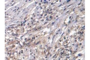 DAB staining on IHC-P; Samples: Human Ovarian cancer Tissue (CTGF antibody  (AA 80-200))