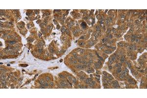 Immunohistochemistry of paraffin-embedded Human ovarian cancer tissue using IKBIP Polyclonal Antibody at dilution 1:40 (IKbIP antibody)