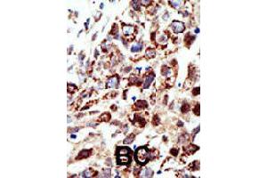 Formalin-fixed and paraffin-embedded human cancer tissue reacted with STAM polyclonal antibody  , which was peroxidase-conjugated to the secondary antibody, followed by AEC staining.