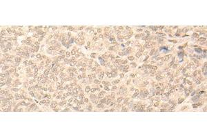 Immunohistochemistry of paraffin-embedded Human ovarian cancer tissue using NARF Polyclonal Antibody at dilution of 1:45(x200) (NARF antibody)